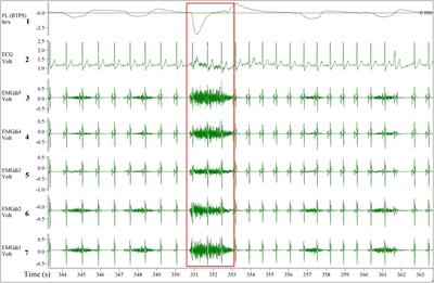 Comparison Between Manual and (Semi-)Automated Analyses of Esophageal Diaphragm Electromyography During Endurance Cycling in Patients With COPD